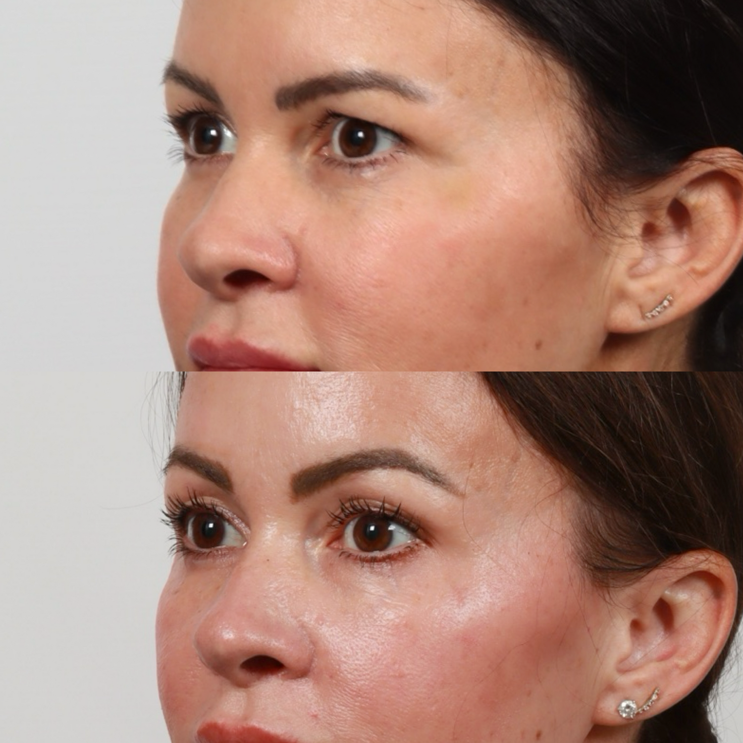 Brow Lift Before & After