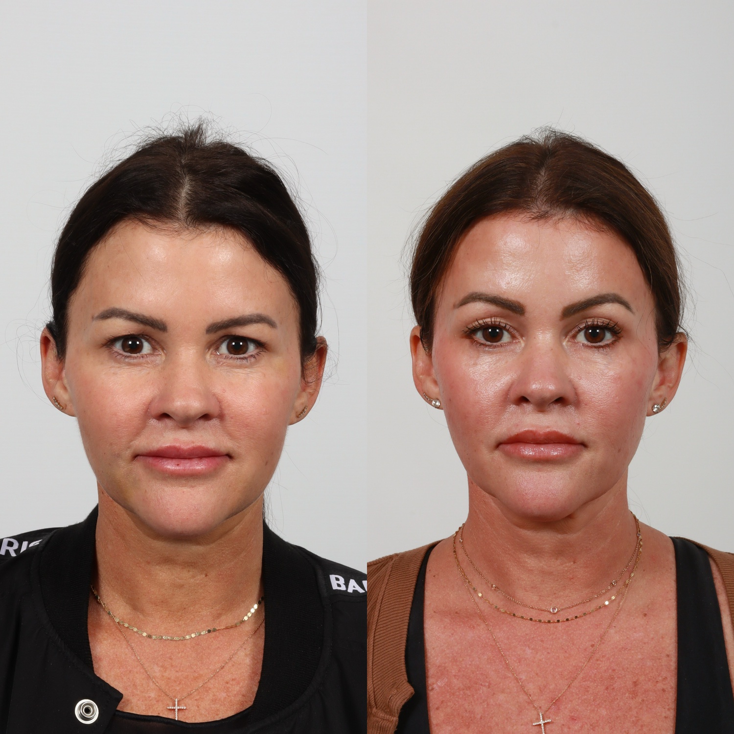 Brow Lift Before & After