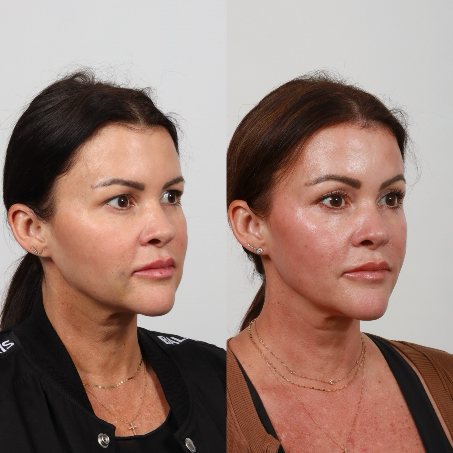 Brow Lift Before & After