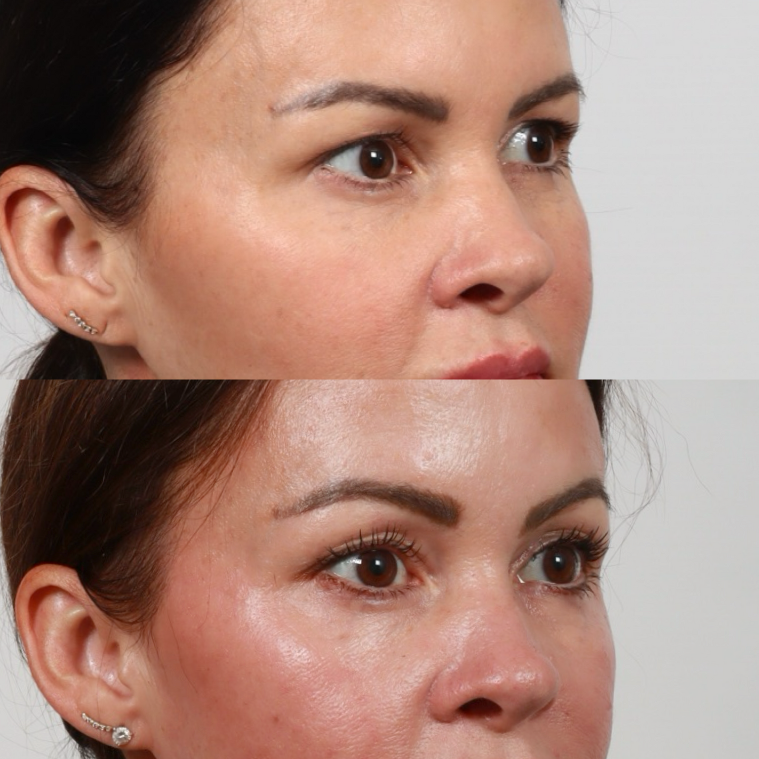 Brow Lift Before & After