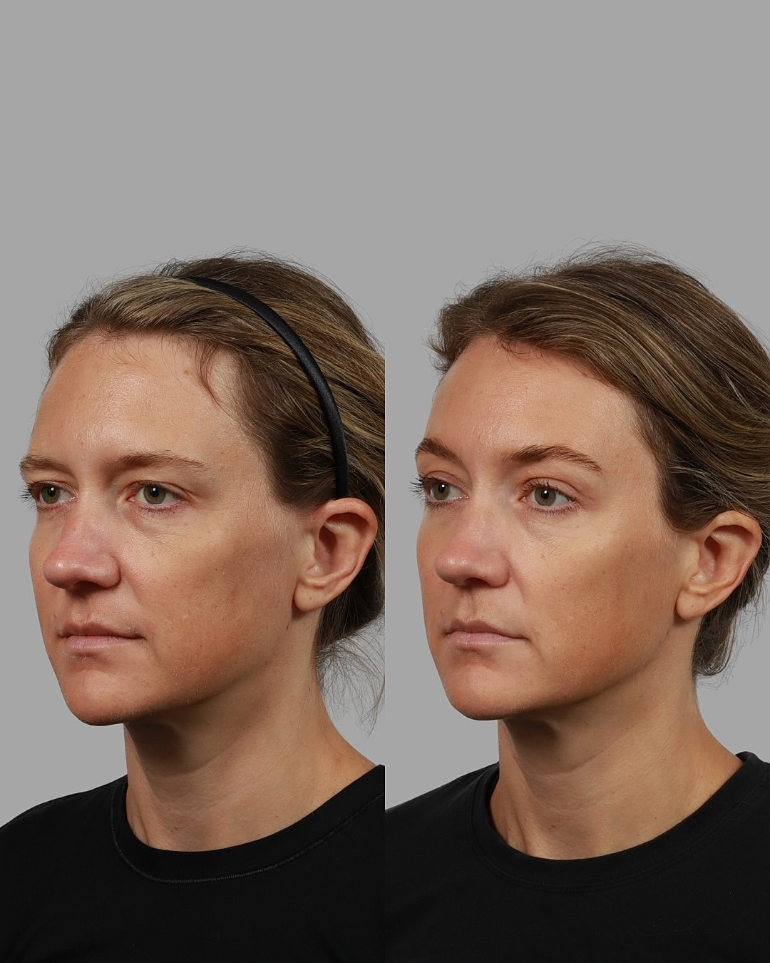 Brow Lift Before & After