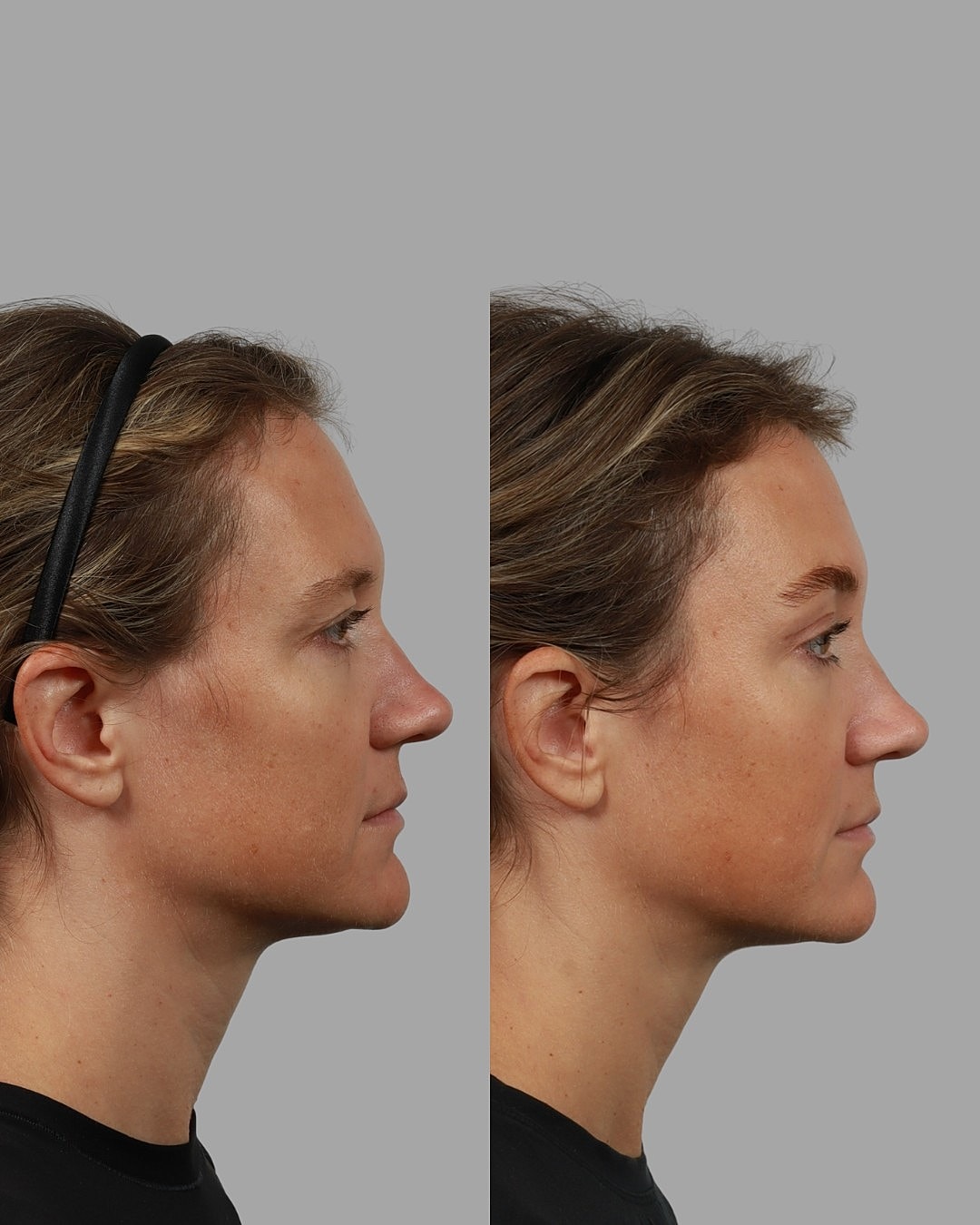 Brow Lift Before & After