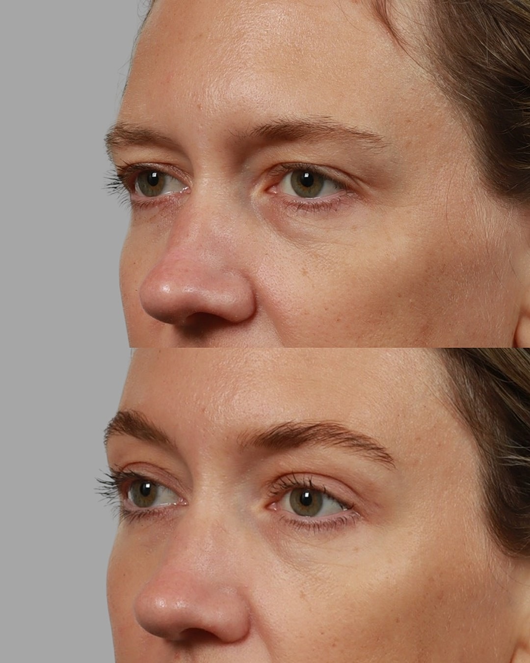 Brow Lift Before & After