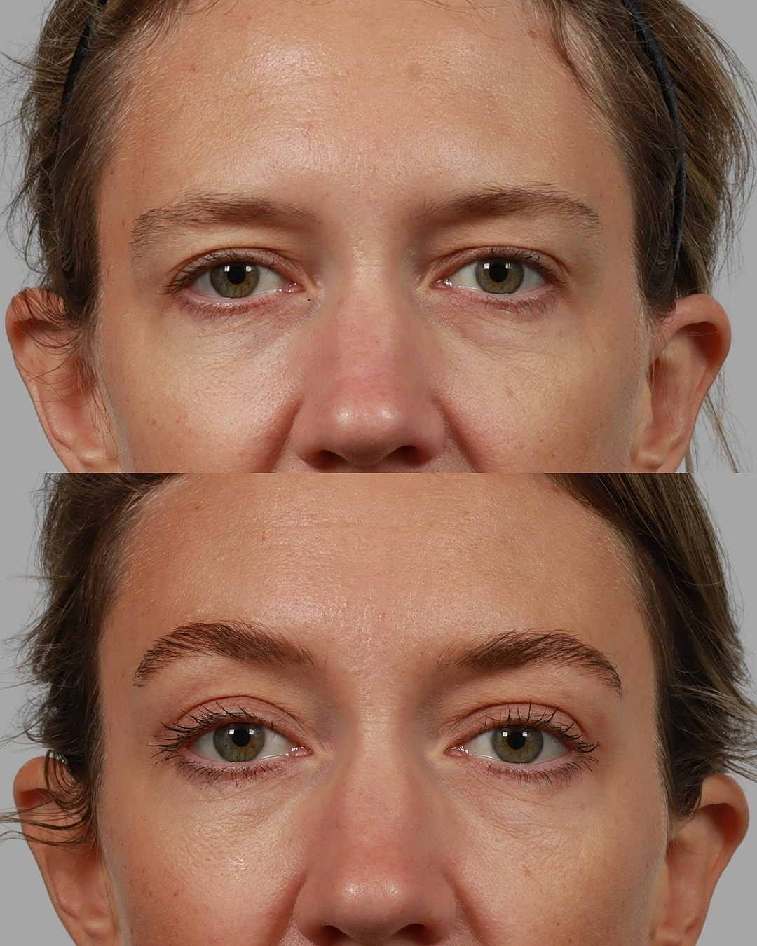 Brow Lift Before & After