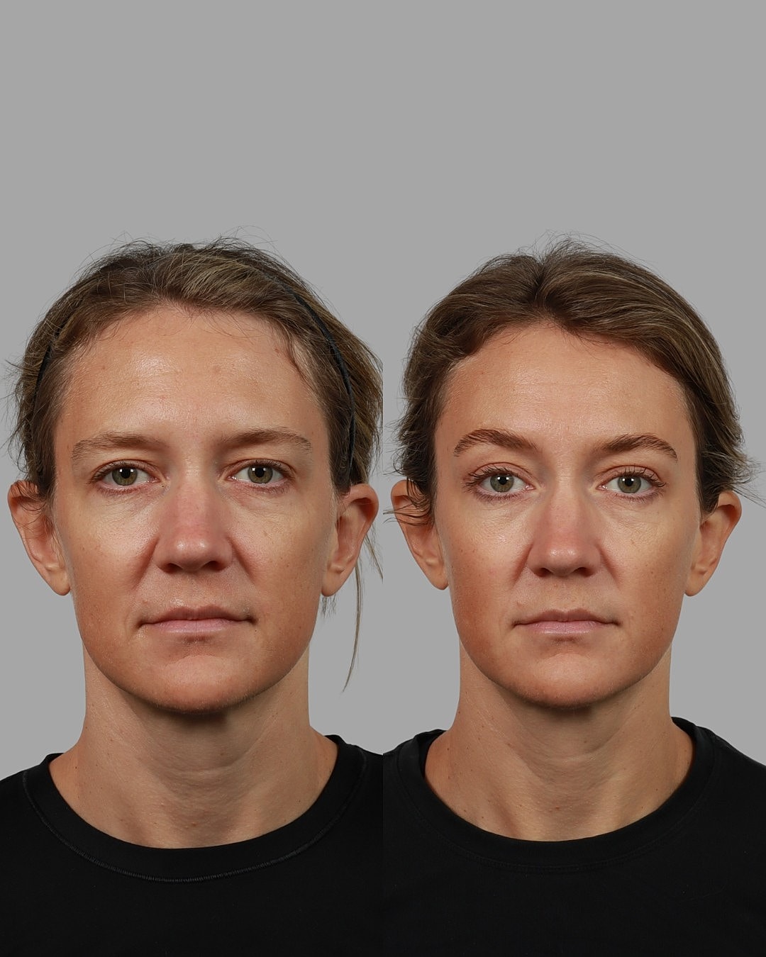 Brow Lift Before & After