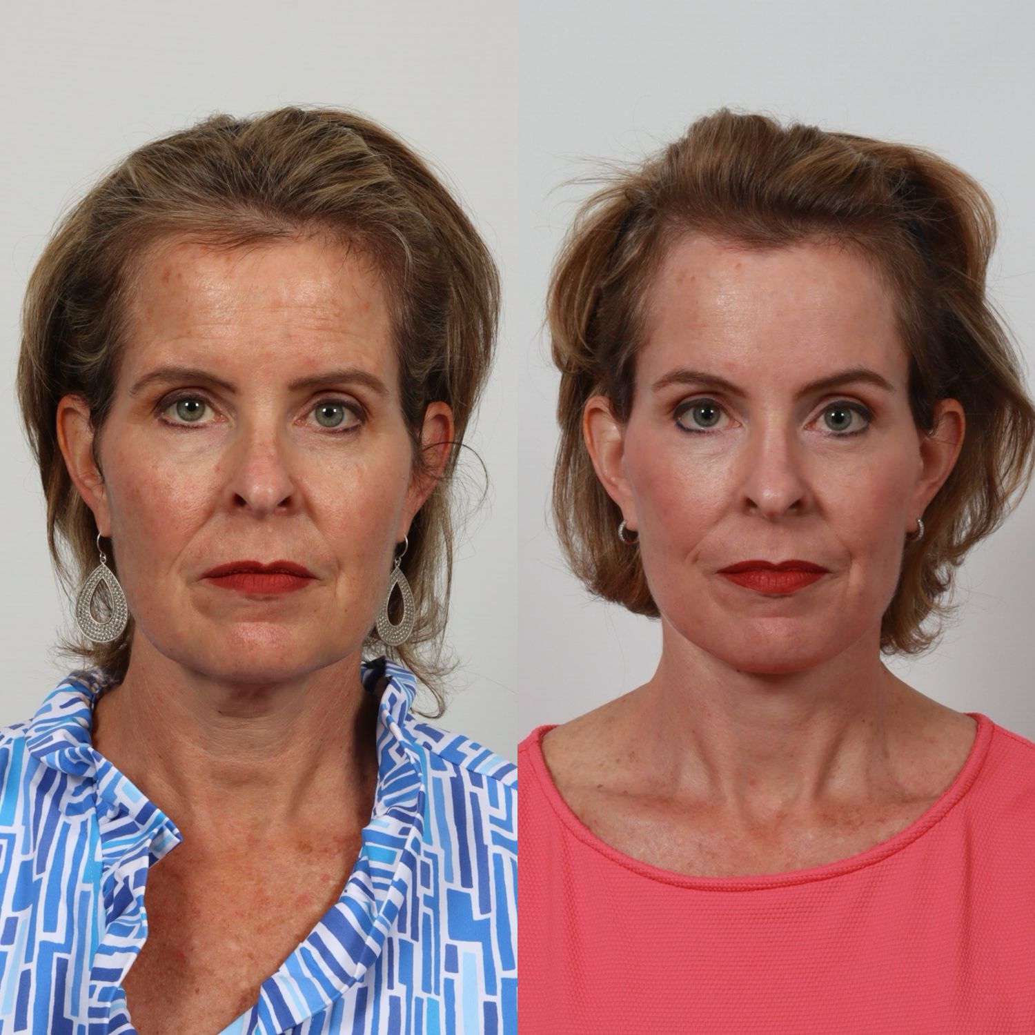 Deep Plane Facelift Before & After
