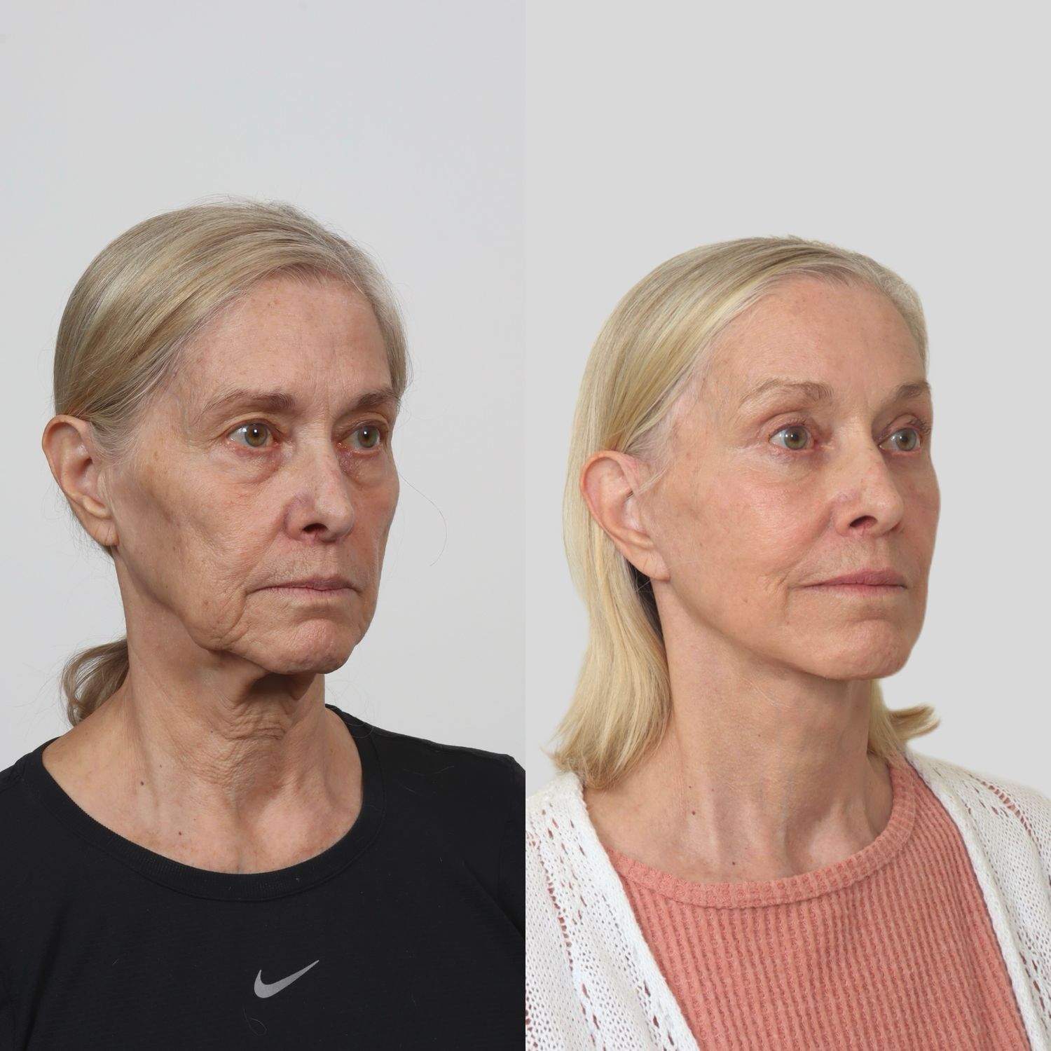 Deep Plane Facelift Before & After