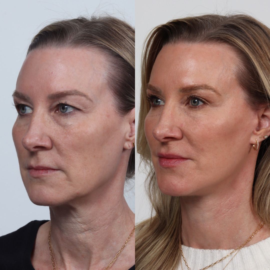 Deep Plane Facelift Before & After