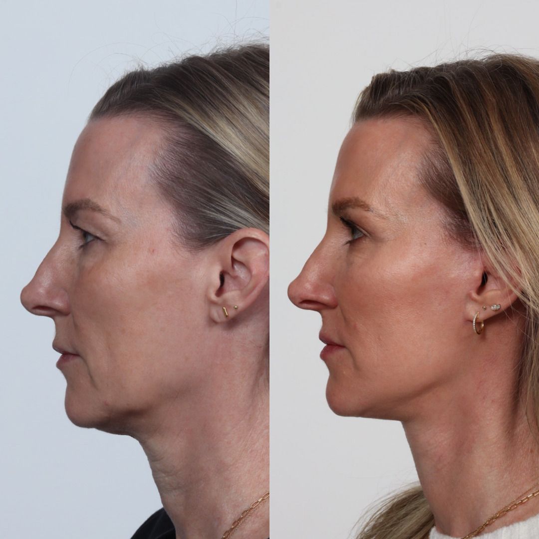 Deep Plane Facelift Before & After