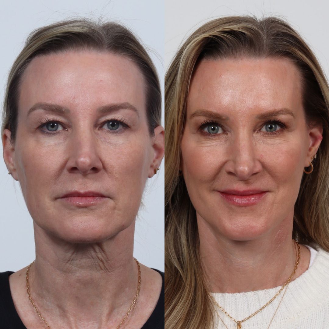 Deep Plane Facelift Before & After