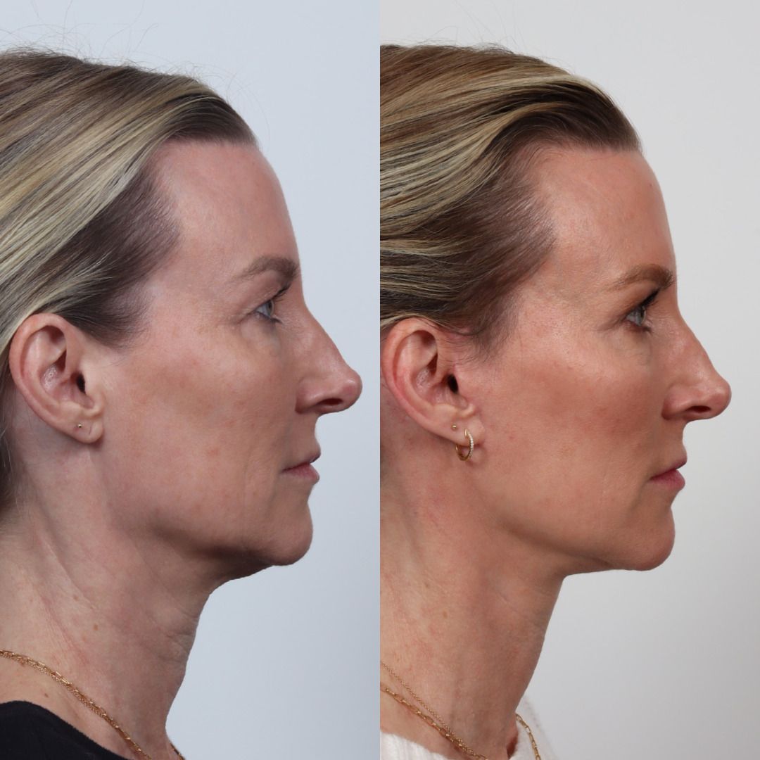 Deep Plane Facelift Before & After