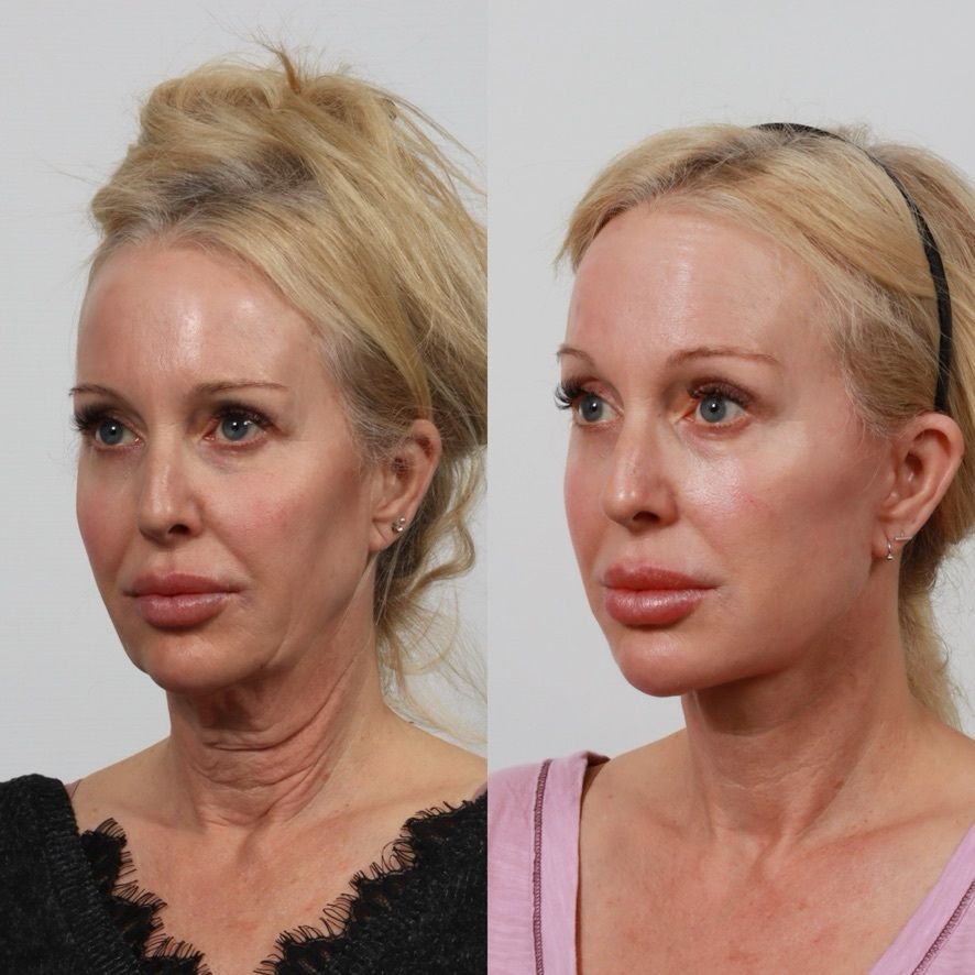 Deep Plane Facelift Before & After