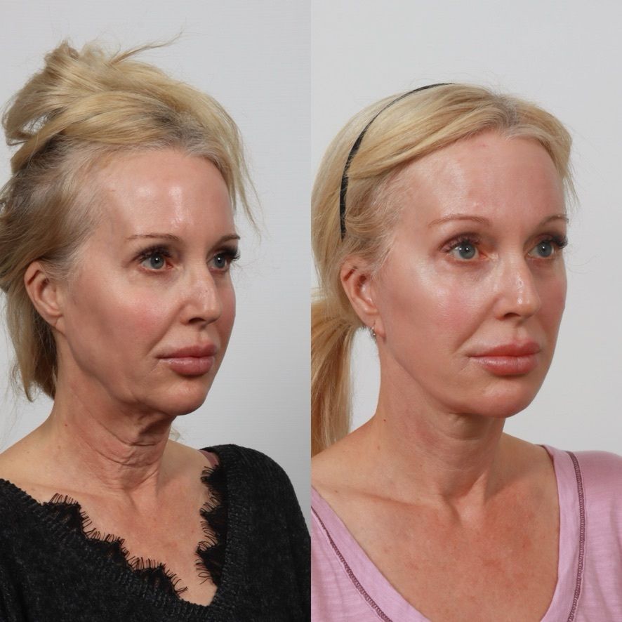 Deep Plane Facelift Before & After