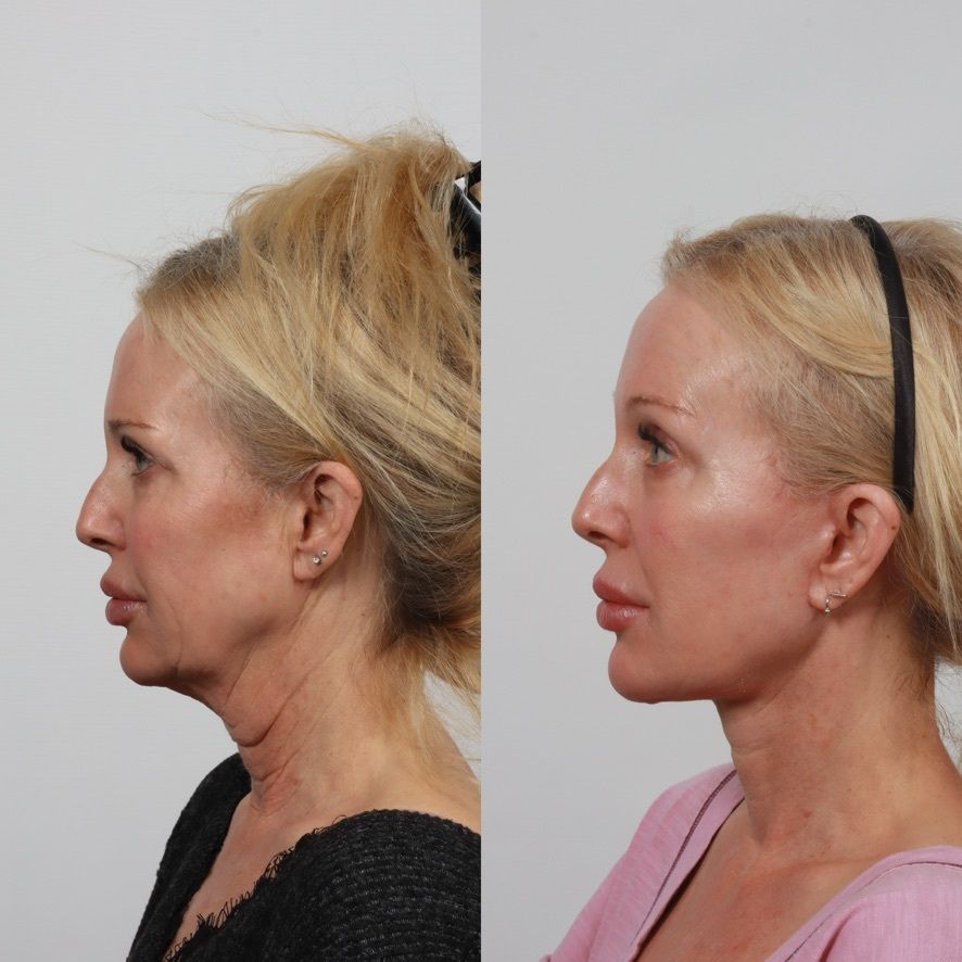 Deep Plane Facelift Before & After