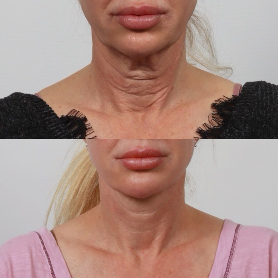 Deep Plane Facelift Before & After
