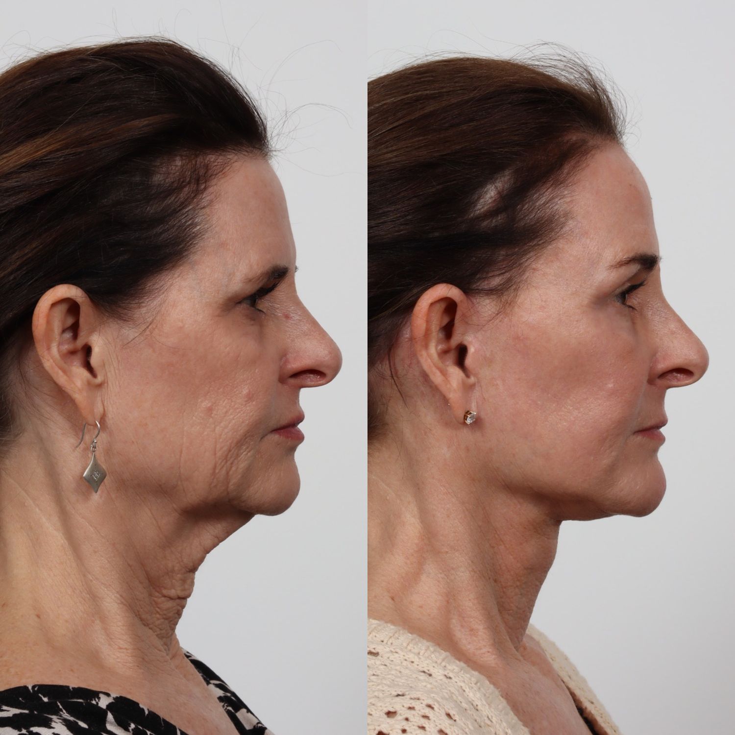 Deep Plane Facelift Before & After