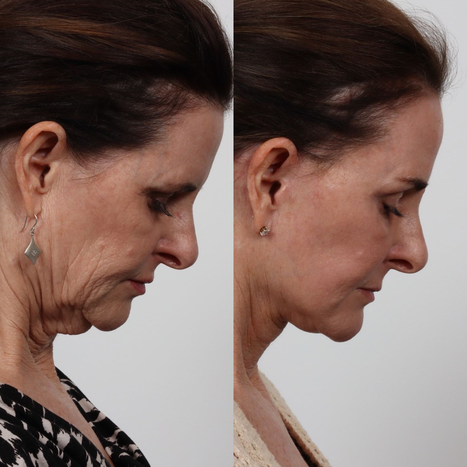 Deep Plane Facelift Before & After