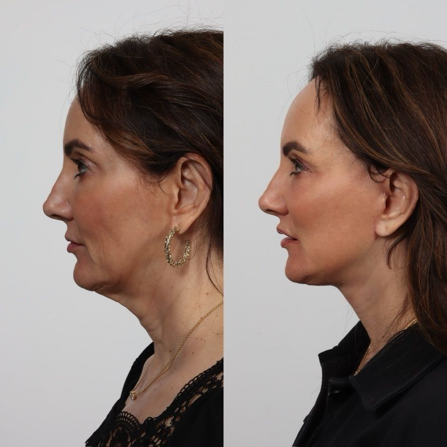 Deep Plane Facelift Before & After