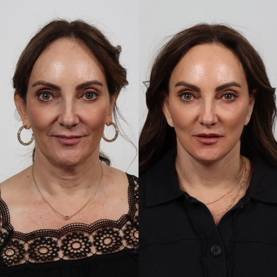 Deep Plane Facelift Before & After