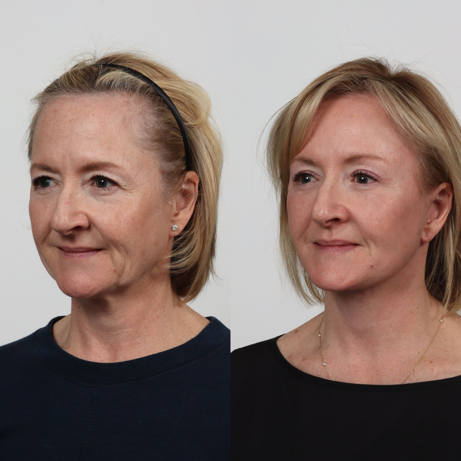 Deep Plane Facelift Before & After