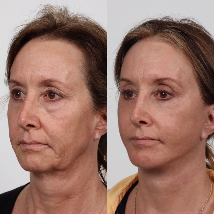 Deep Plane Facelift Before & After