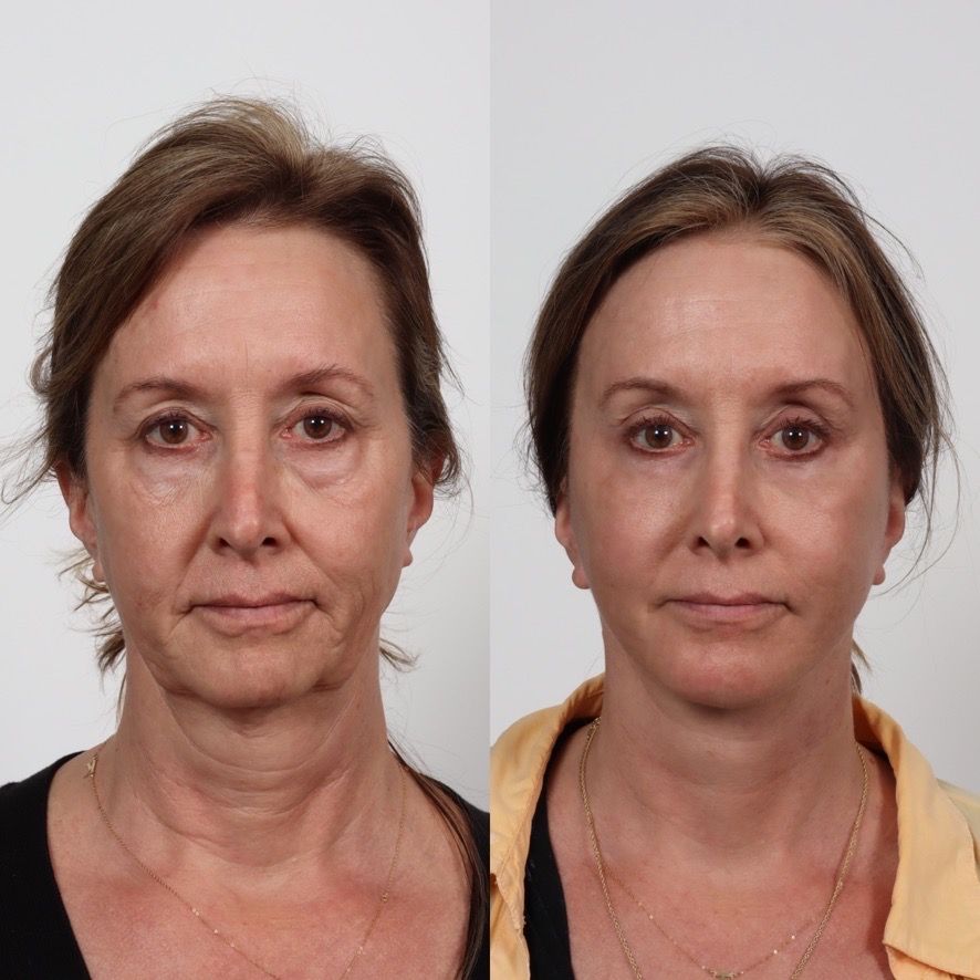 Deep Plane Facelift Before & After