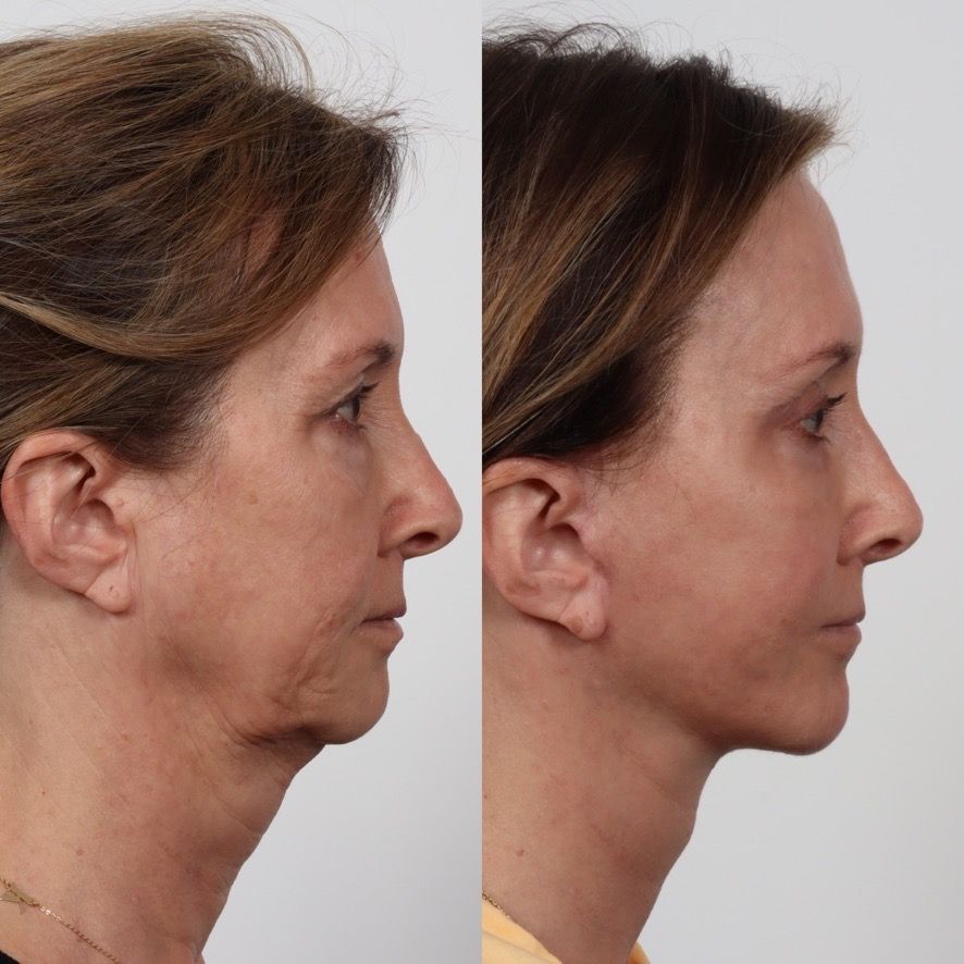 Deep Plane Facelift Before & After