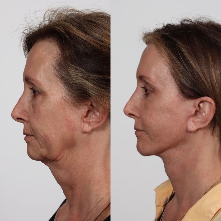 Deep Plane Facelift Before & After