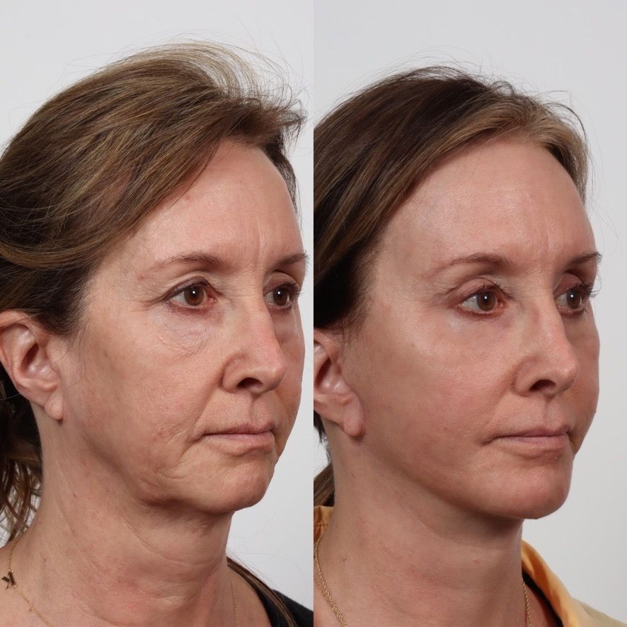 Deep Plane Facelift Before & After