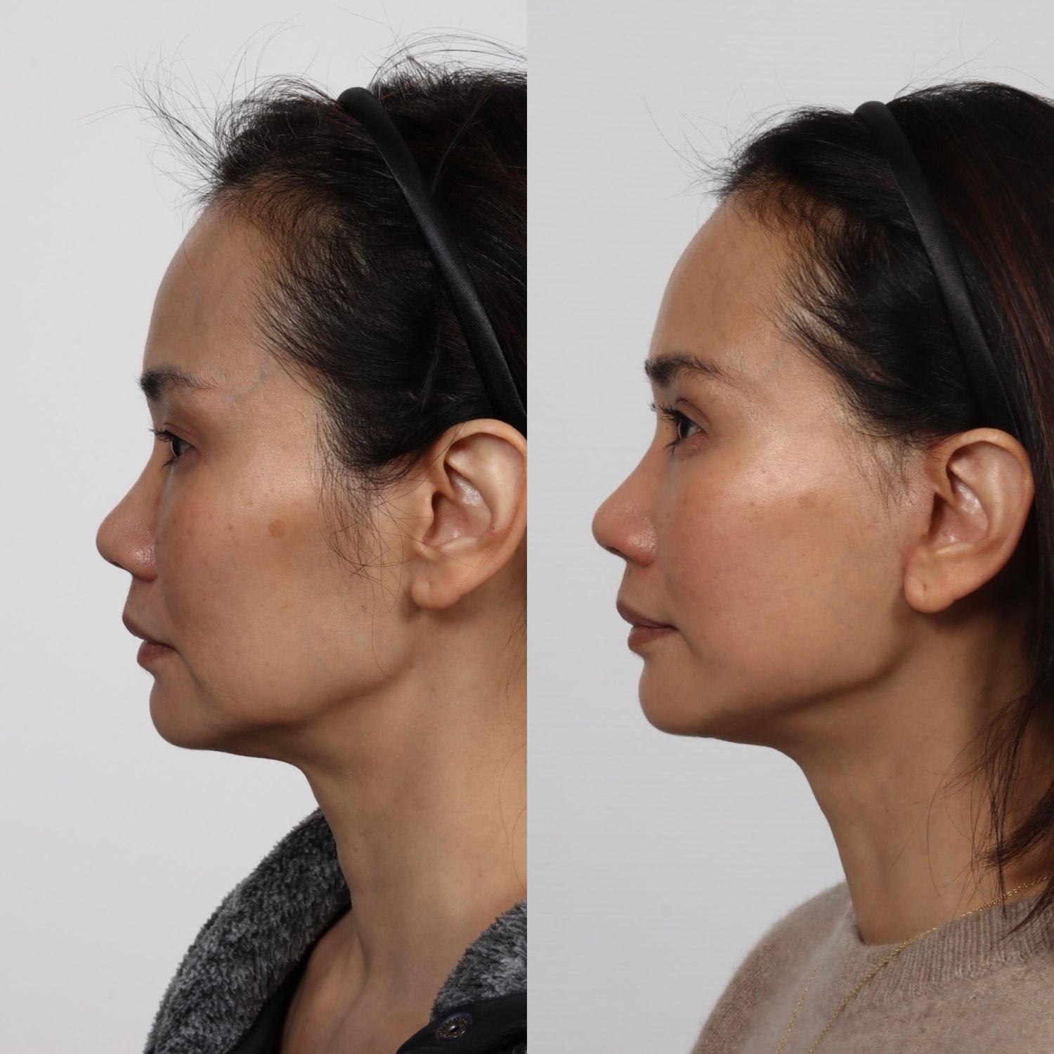 Deep Plane Facelift Before & After