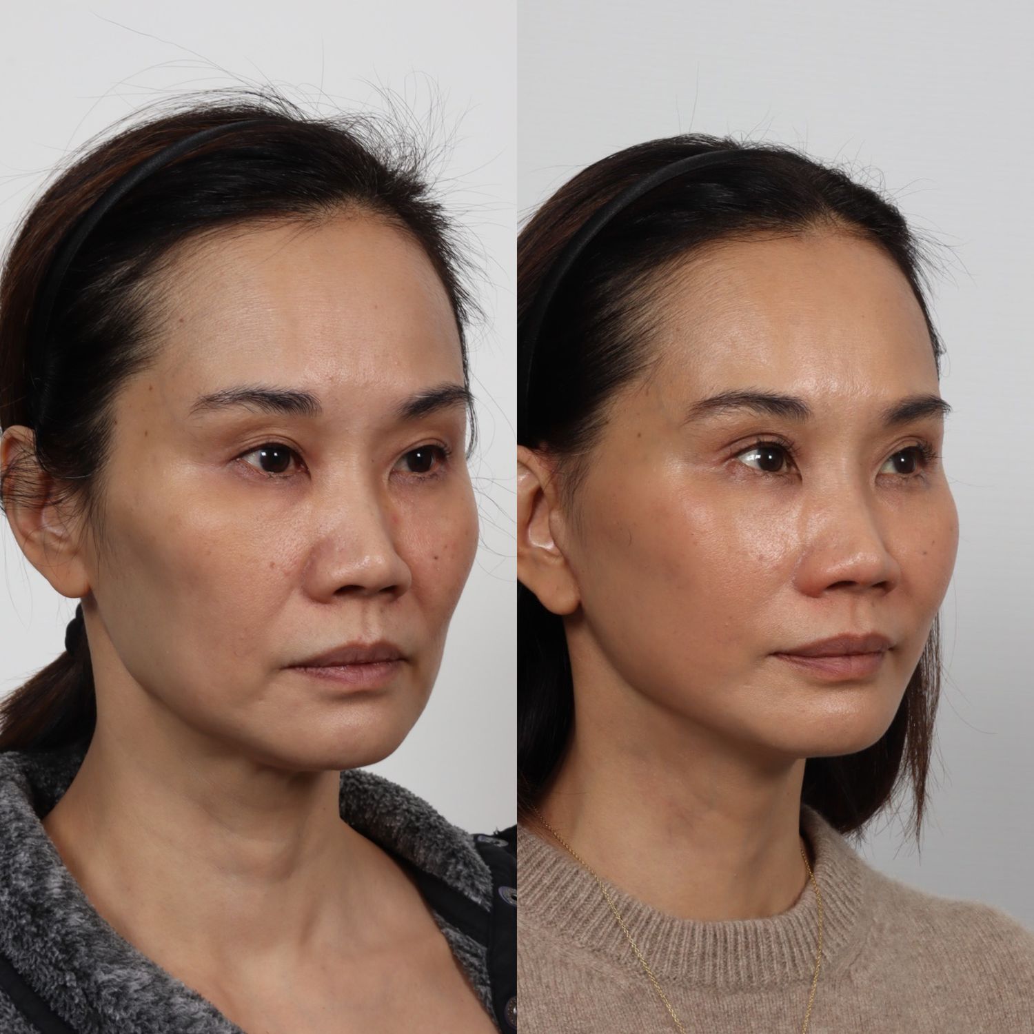 Deep Plane Facelift Before & After