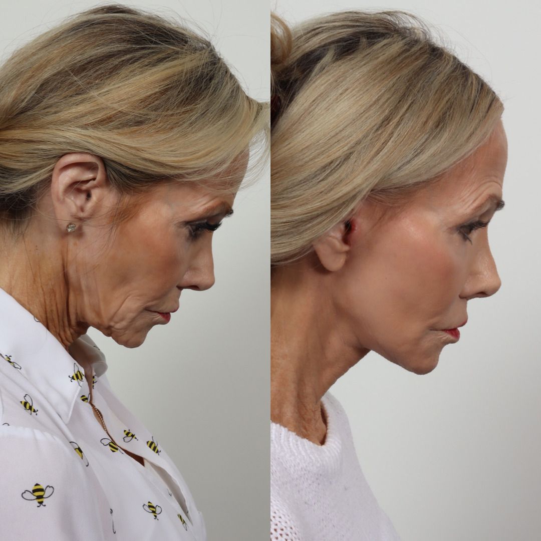 Deep Plane Facelift Before & After