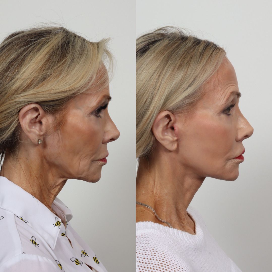 Deep Plane Facelift Before & After