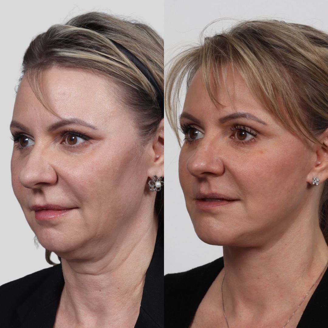 Deep Plane Facelift Before & After