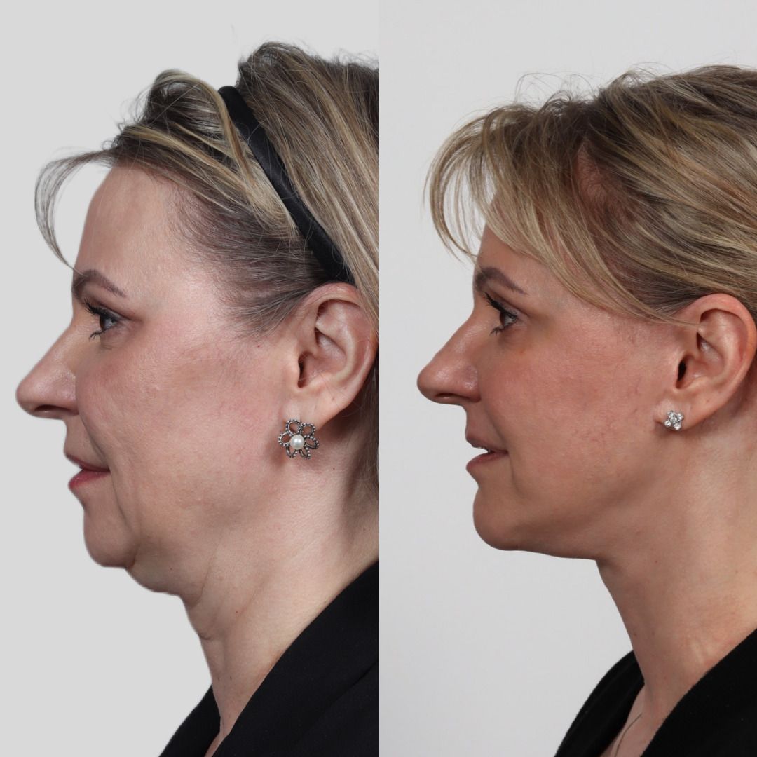 Deep Plane Facelift Before & After