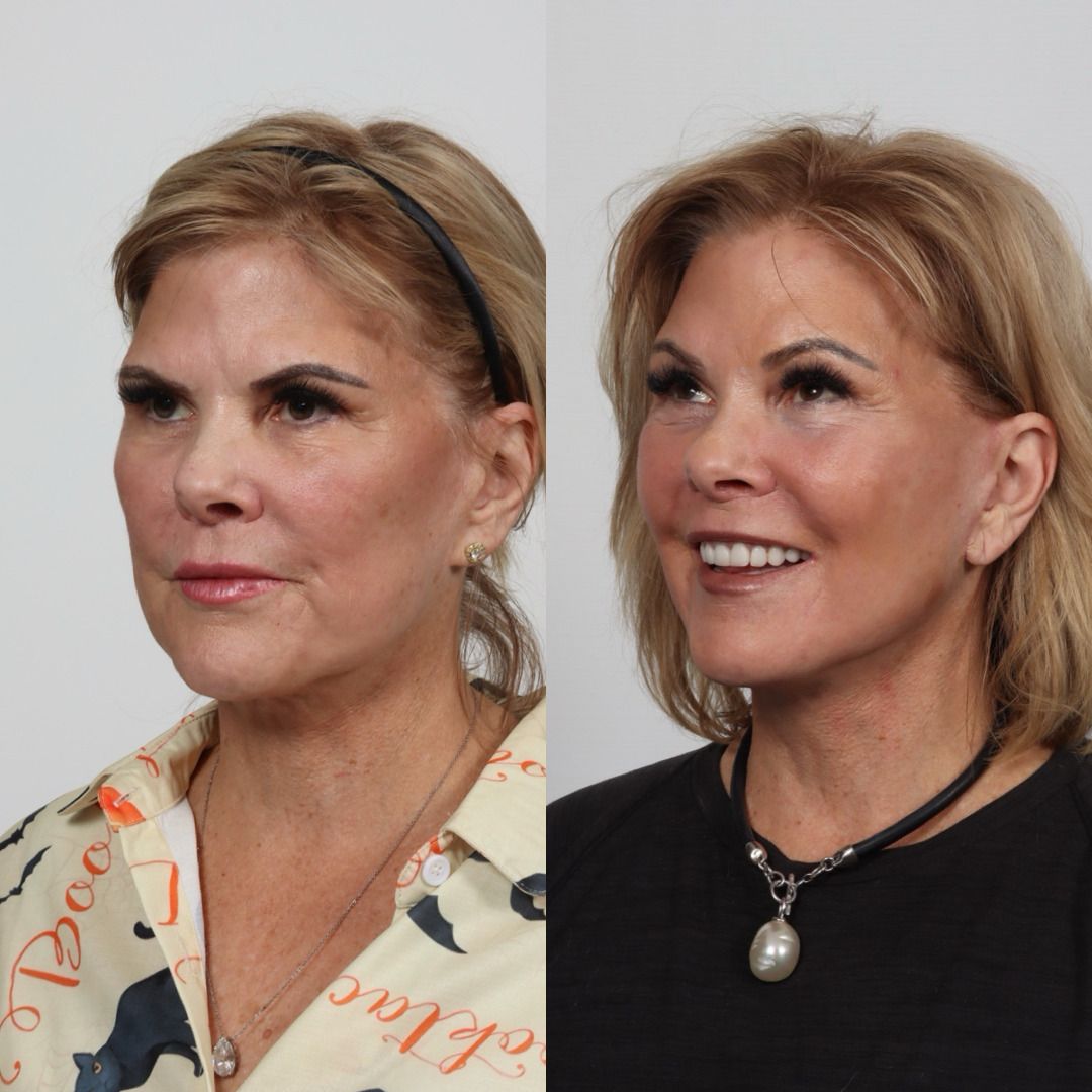 Deep Plane Facelift Before & After