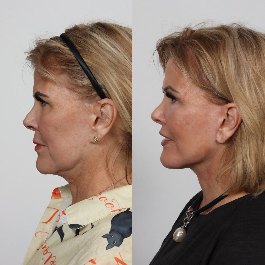 Deep Plane Facelift Before & After