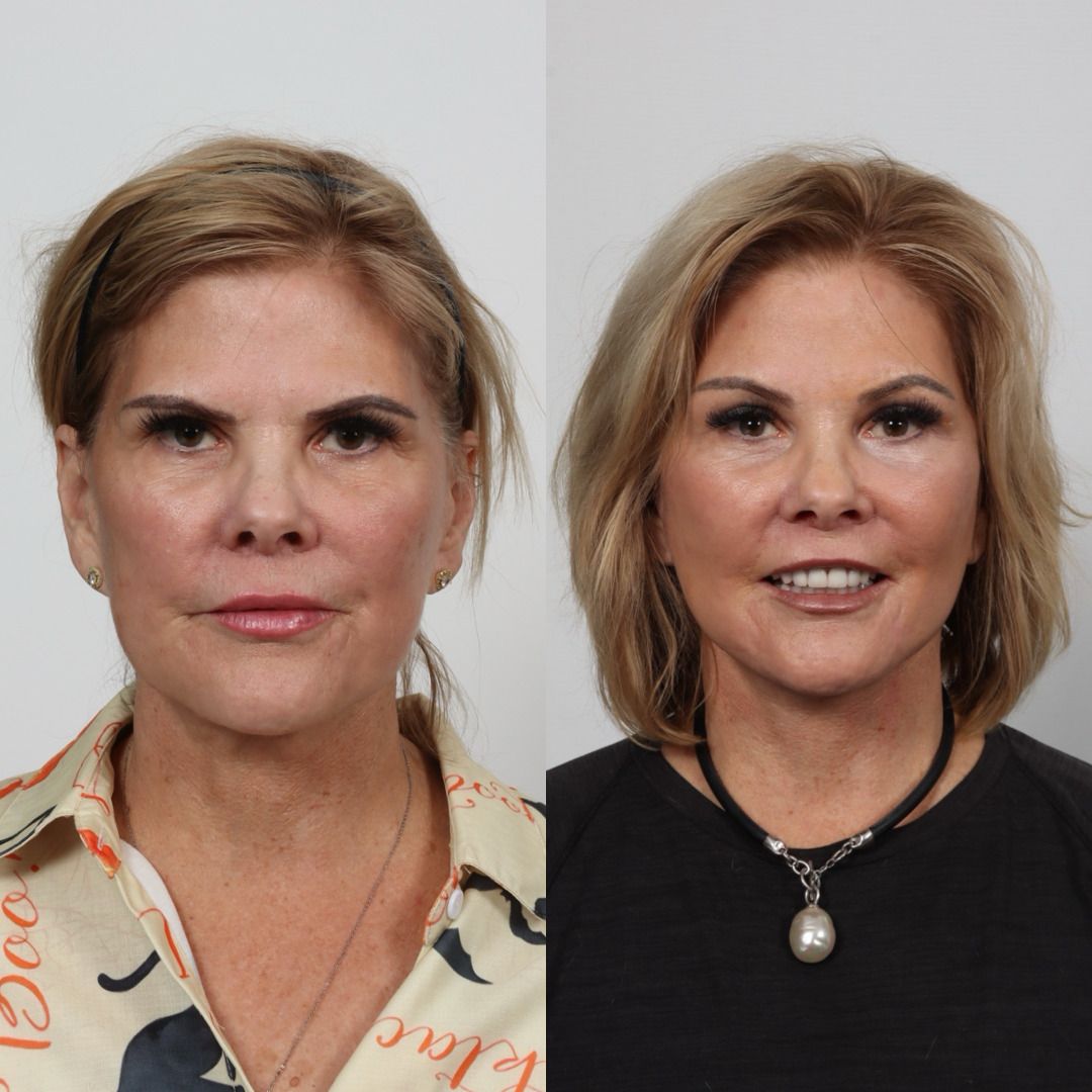 Deep Plane Facelift Before & After