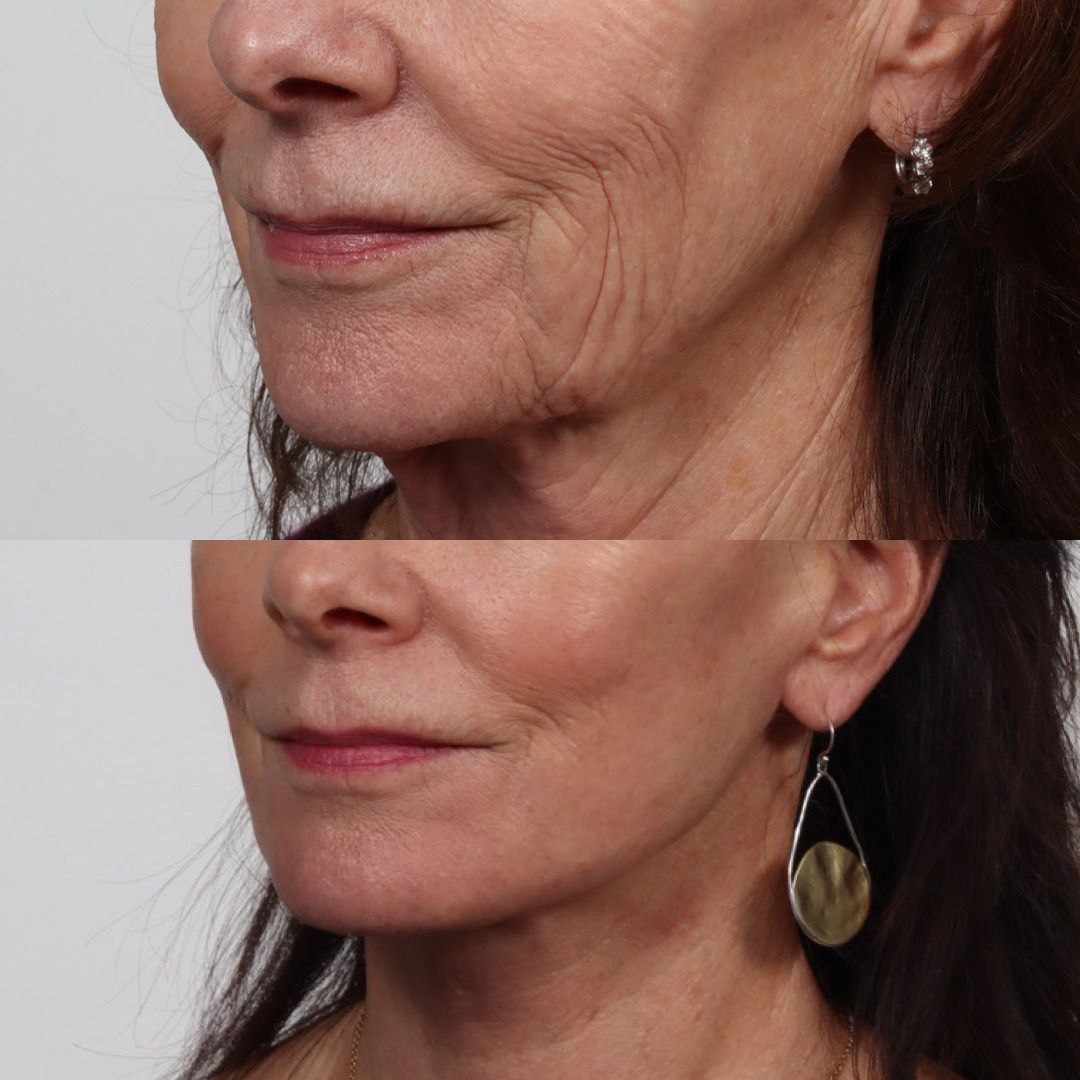 Deep Plane Facelift Before & After