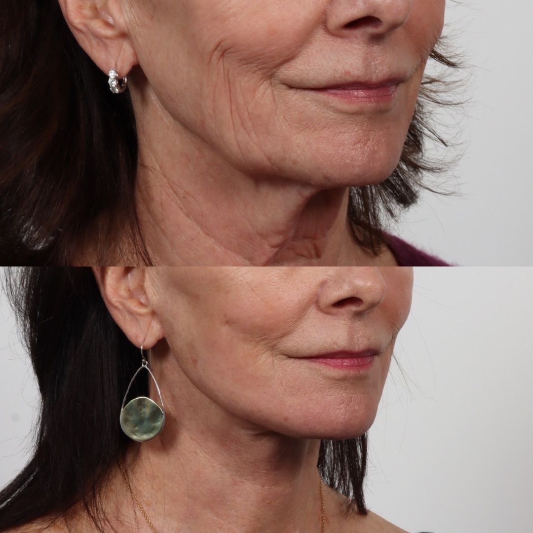 Deep Plane Facelift Before & After