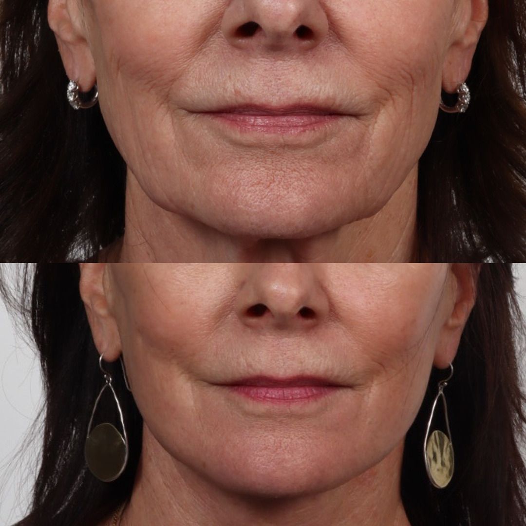 Deep Plane Facelift Before & After