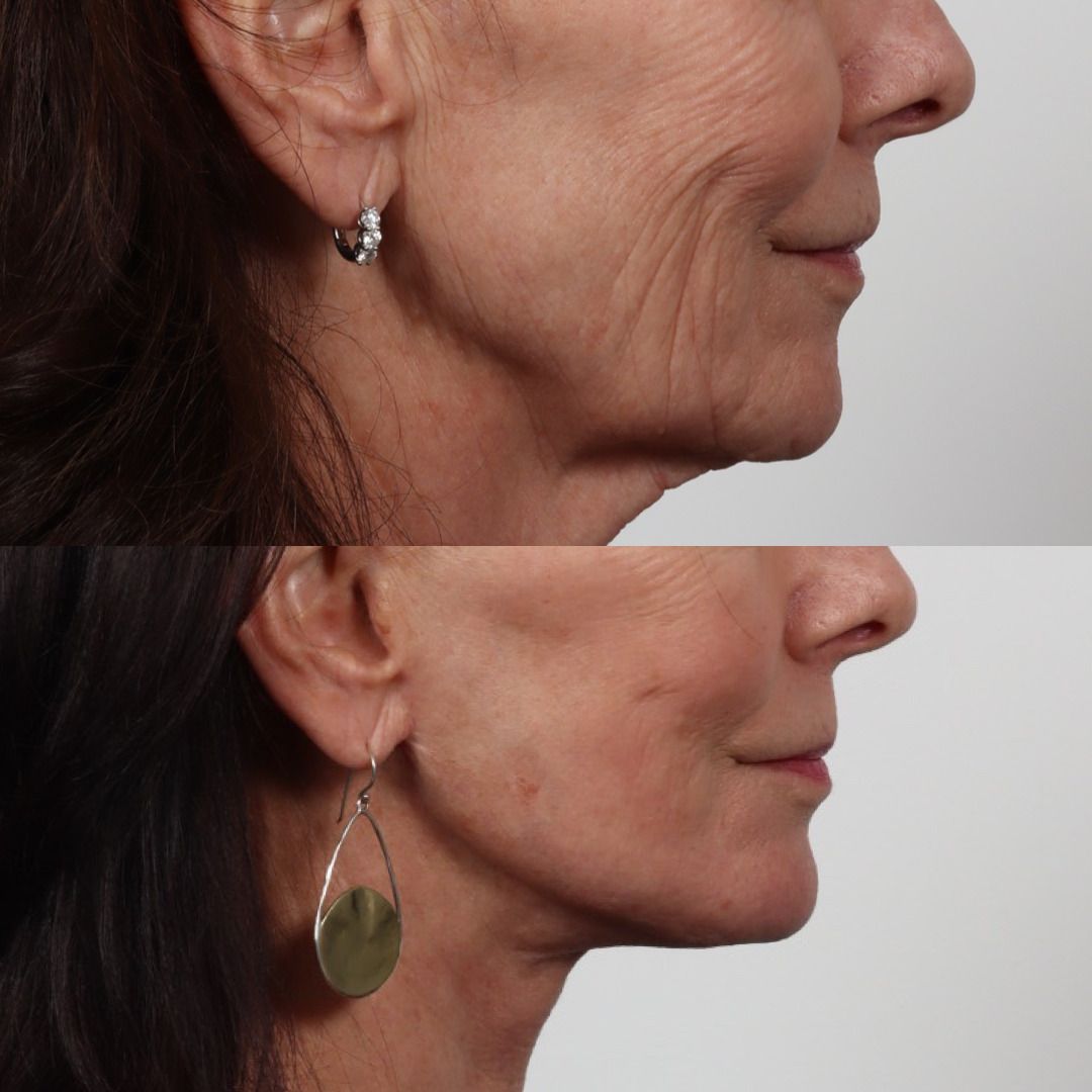 Deep Plane Facelift Before & After
