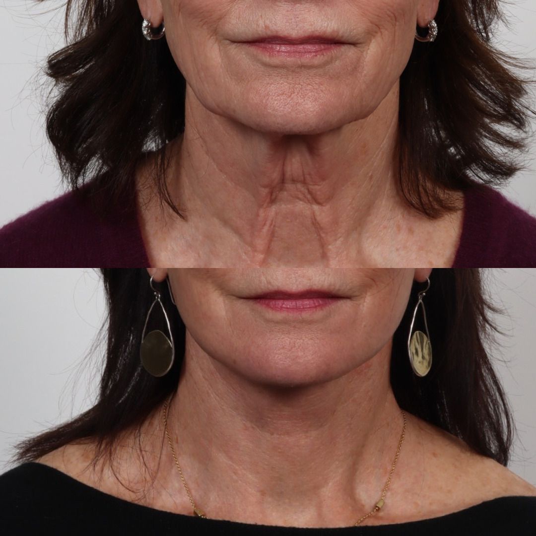 Deep Plane Facelift Before & After