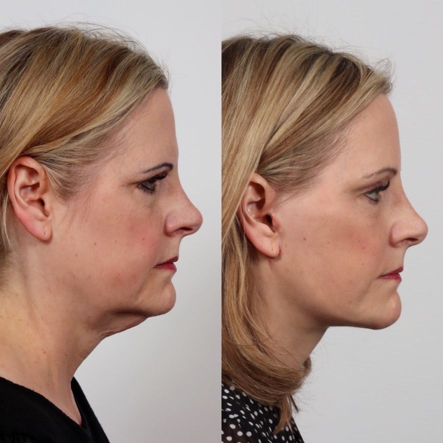 Deep Plane Facelift Before & After