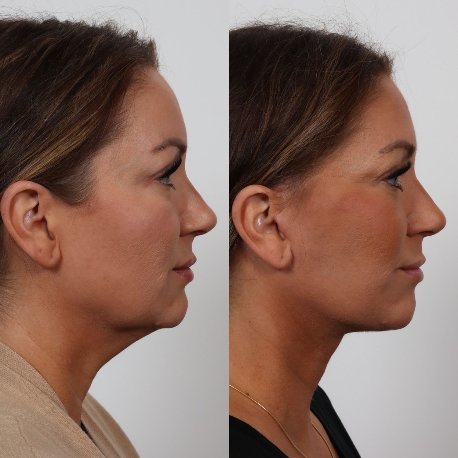 Deep Plane Facelift Before & After
