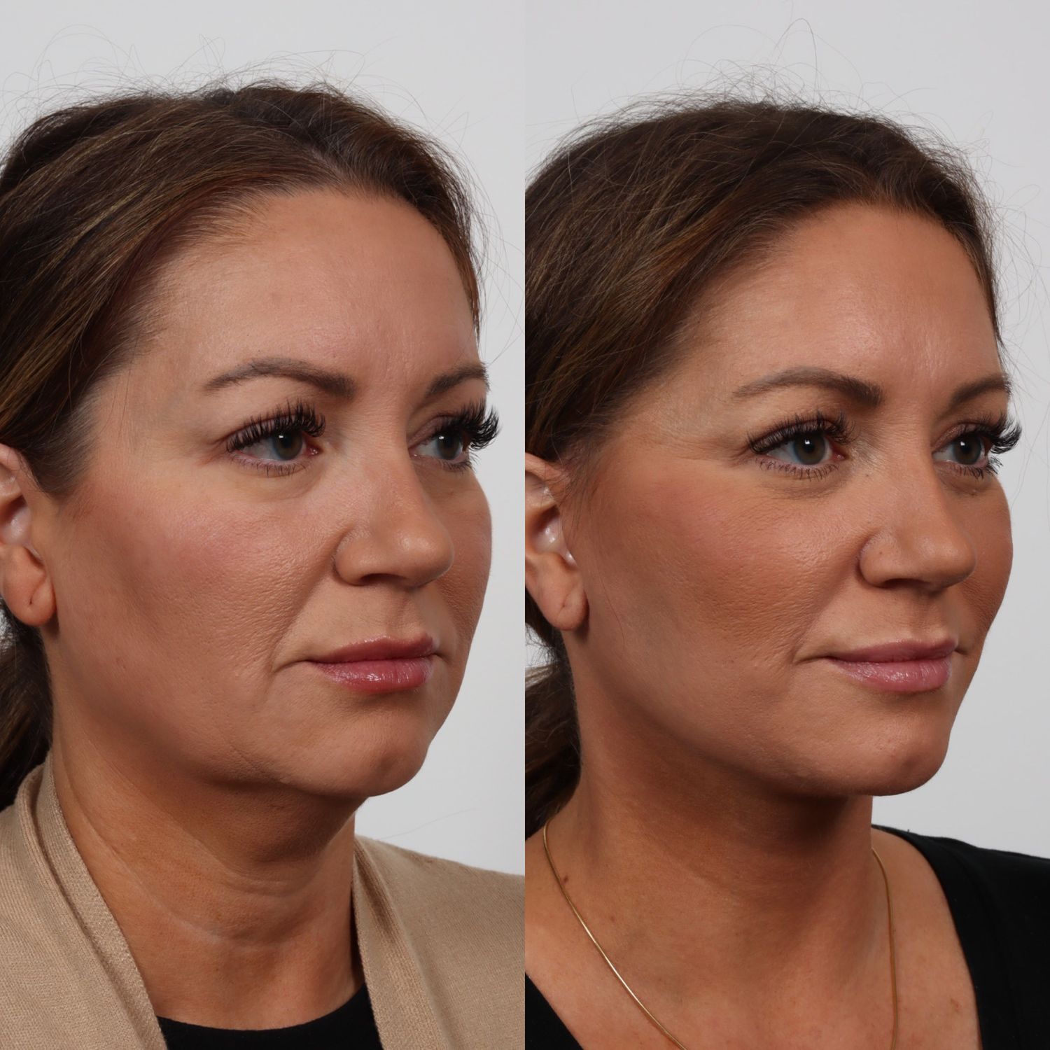 Deep Plane Facelift Before & After