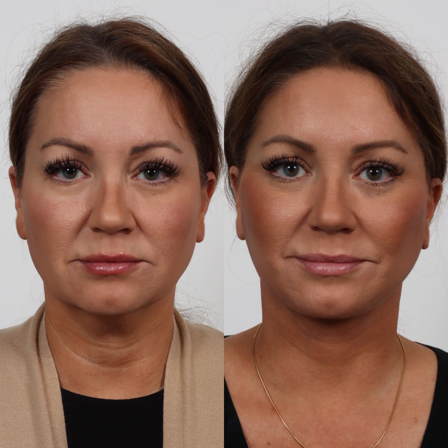 Deep Plane Facelift Before & After
