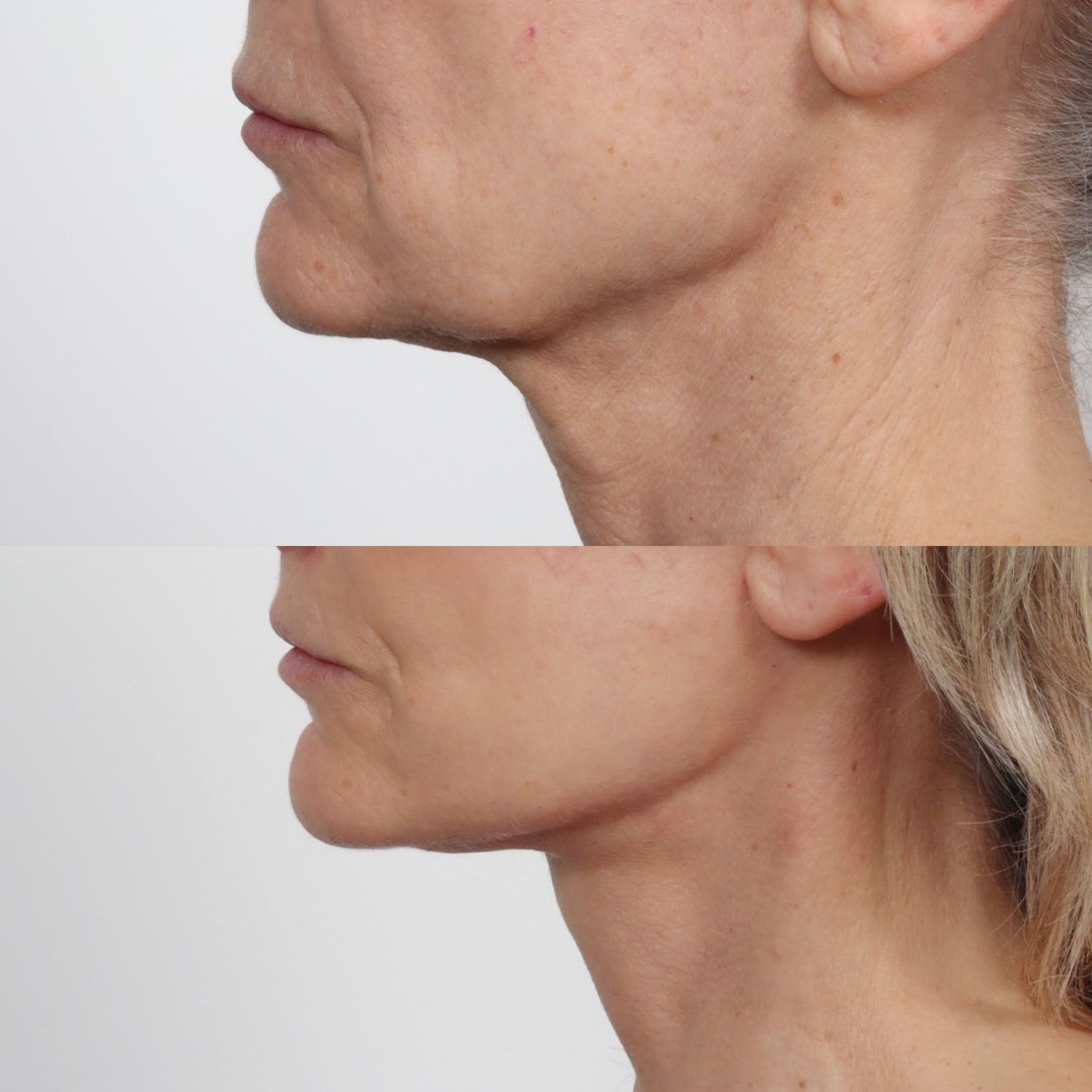 Deep Plane Facelift Before & After