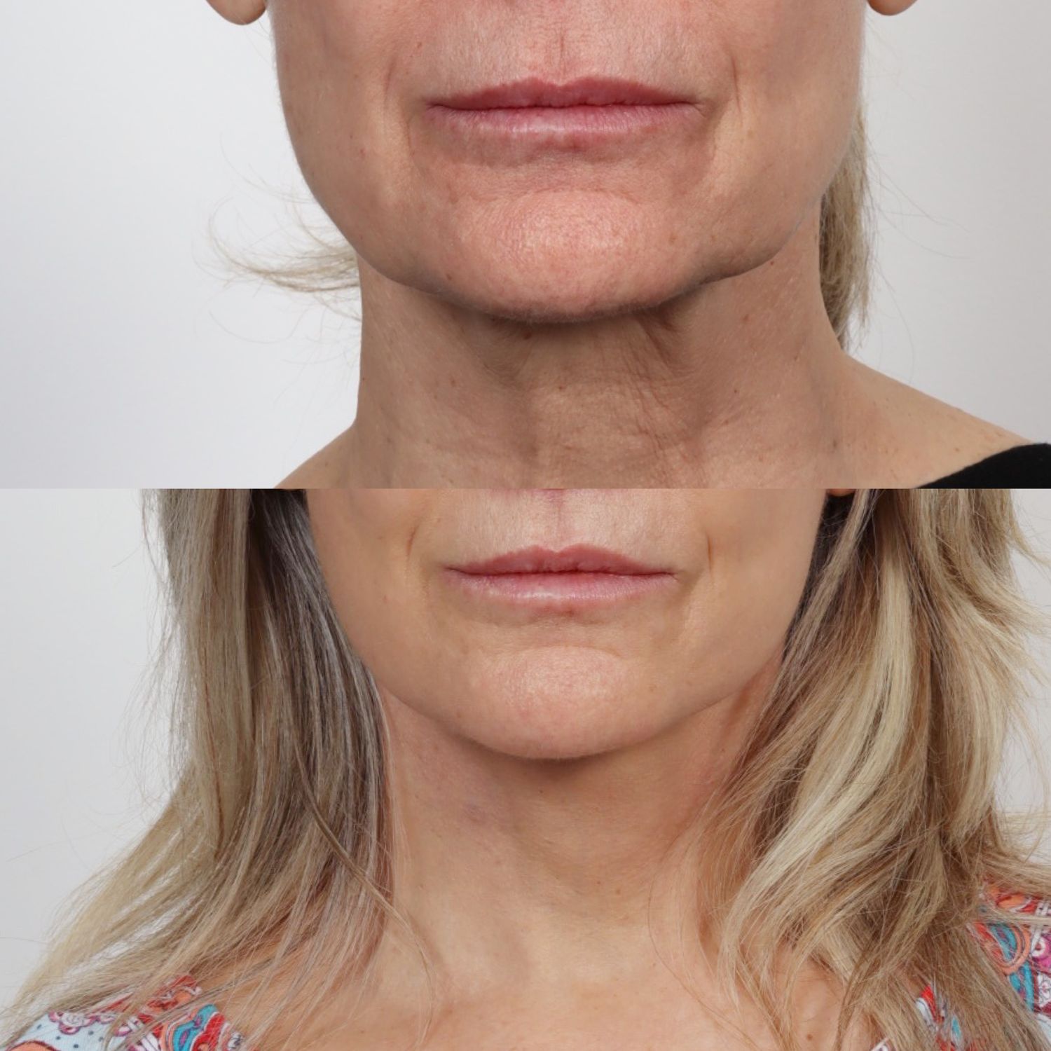 Deep Plane Facelift Before & After