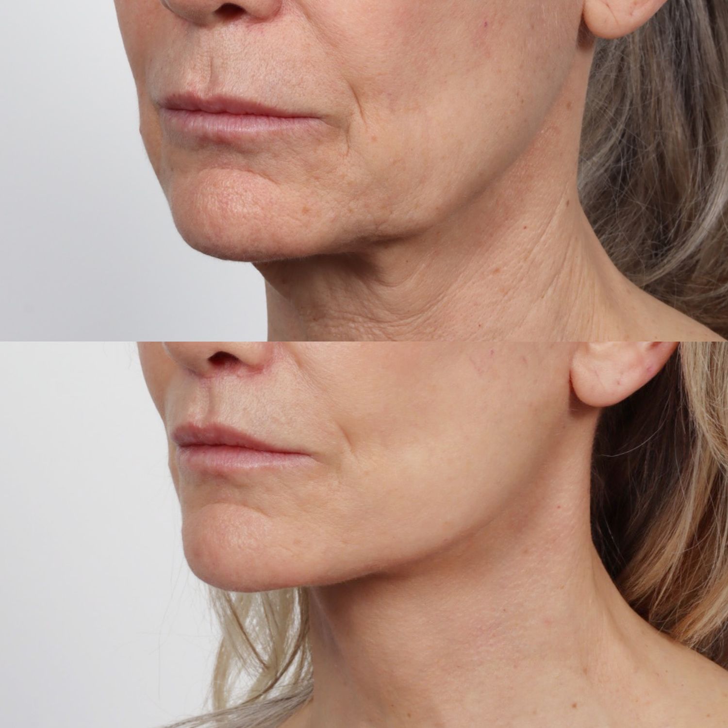 Deep Plane Facelift Before & After